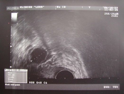 овуляция на узи