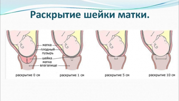 раскрытие шейки матки