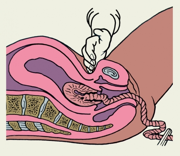 изгнание плаценты