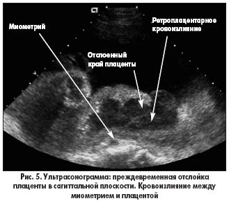 узи при отслойки плаценты
