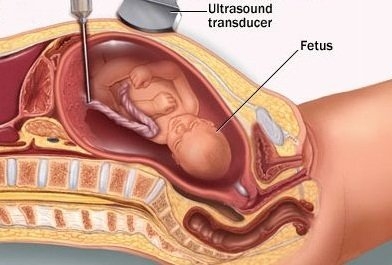 Пункция пуповины