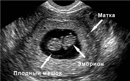 Фото УЗИ 6 неделя беременности