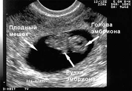 Фото УЗИ 9 неделя беременности