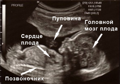 Фото УЗИ 13 неделя беременности