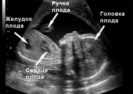 Фото УЗИ 20 неделя беременности