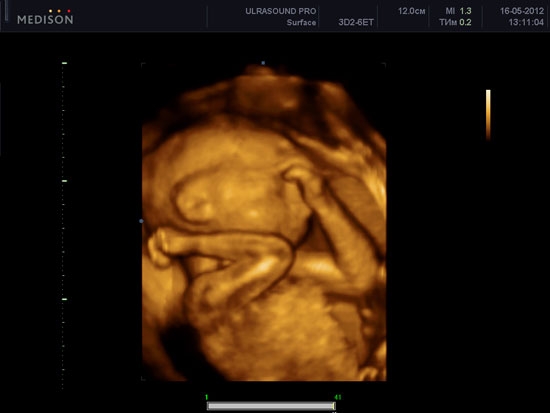 Фото УЗИ 27 неделя беременности