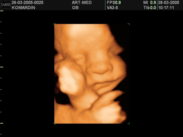 Фото УЗИ 30 неделя беременности