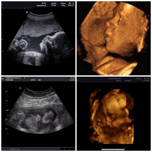 Фото УЗИ 31 неделя беременности