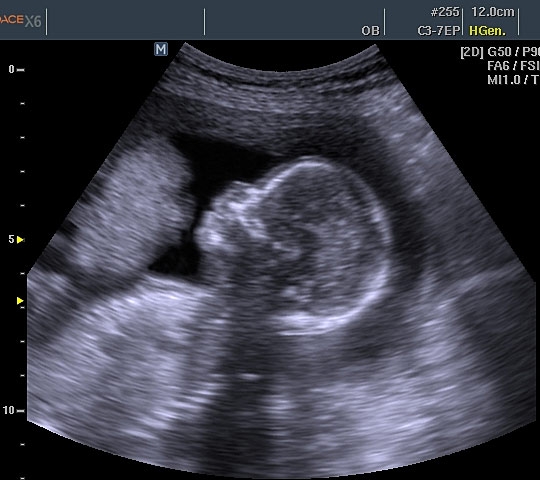 Фото УЗИ 32 неделя беременности