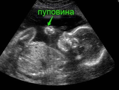 Фото УЗИ 33 неделя беременности