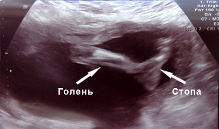 Фото УЗИ 36 неделя беременности