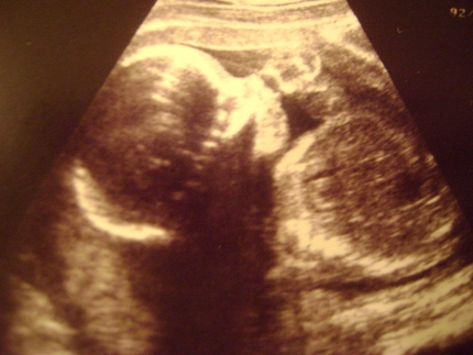 Фото УЗИ 37 неделя беременности