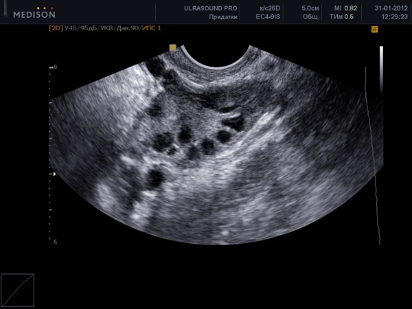 узи 1 неделя беременности мелкие фолликулы