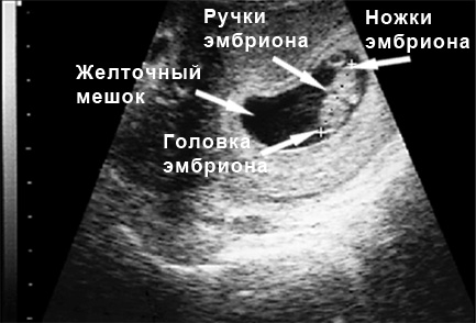 фото УЗИ на 8 неделе беременности