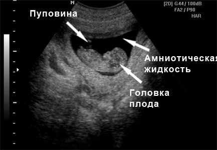УЗИ на 10 неделе беременности
