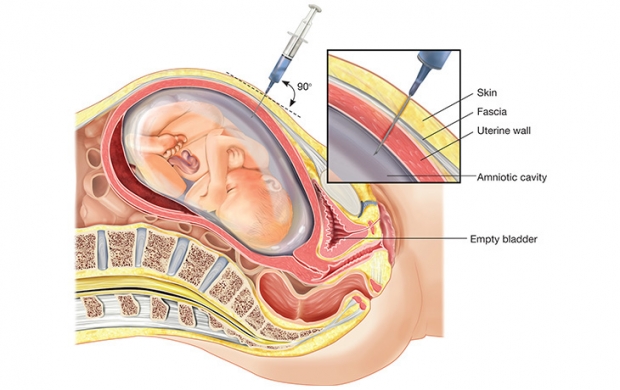 Амниоцентез