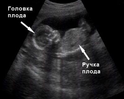 Фото УЗИ на 15 неделе беременности