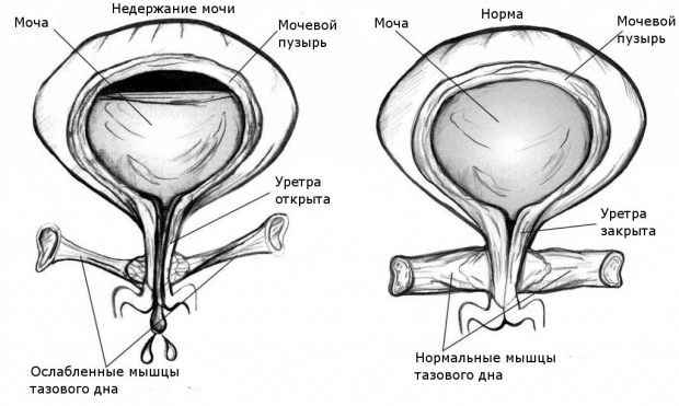 Причины недержания мочи после родов