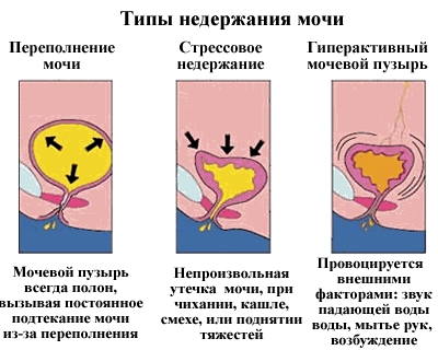 типы недержания мочи