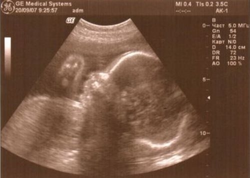 Фото УЗИ на 27 неделе беременности