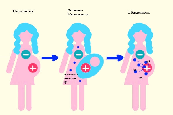 Резус конфликт при второй беременности