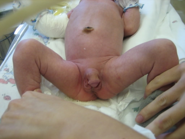 Адреногенитальный синдром у новорожденного