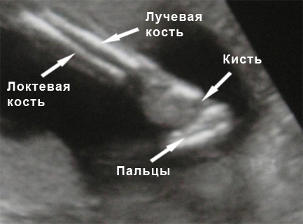 Фото УЗИ на 32 неделе беременности