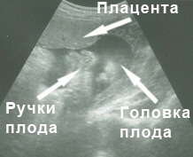 Фото УЗИ на 33 неделе беременности