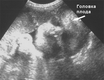 Фото УЗИ на 35 неделе беременности