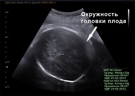 Фото УЗИ на 40 неделе беременности
