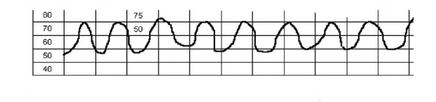 Чрезмерные схватки