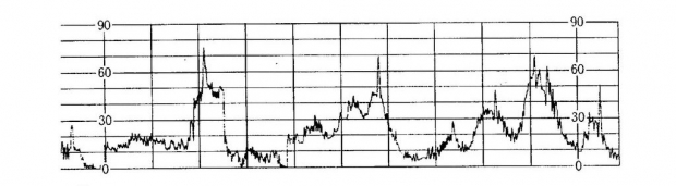 Дискоординированные схватки
