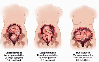 Виды предлежания плода