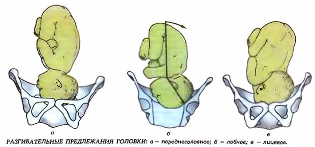 разгибательные виды предлежания плода