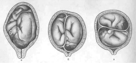 Положение плодов при двойне