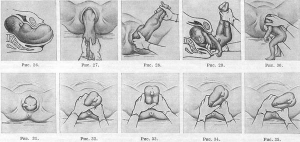 роды в тазовом предлежание