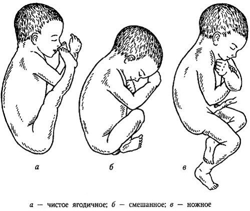 Виды тазового предлежания