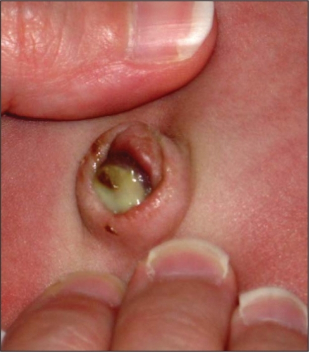 Воспаление пупка у новорожденных: фото