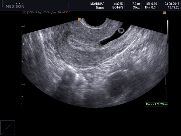 Внематочная беременность: фото УЗИ