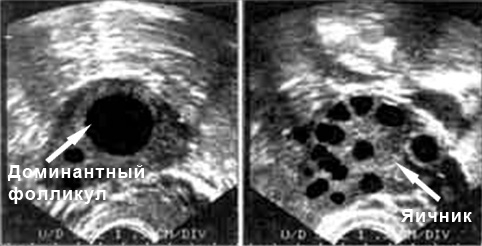 доминантный фолликул на узи