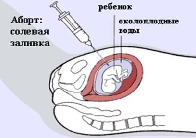 Солевой аборт