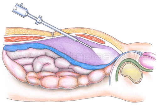 Герниопластика