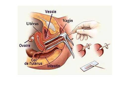 взятие мазка из влагалища