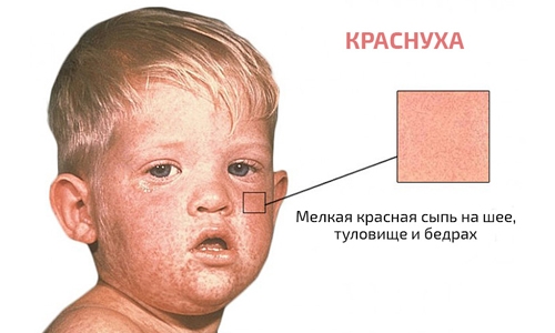 Краснуха у детей