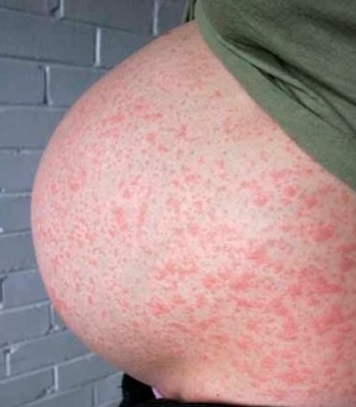 Краснуха у беременных