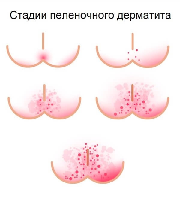 Опрелости у новорожденных детей стадии