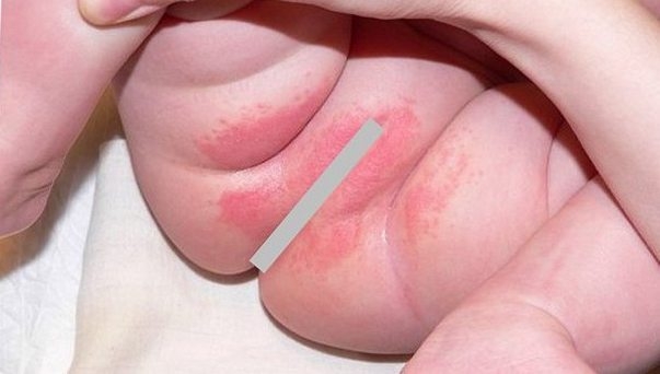 Опрелости у новорожденных детей