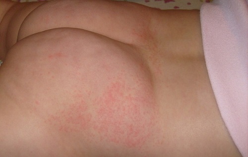 аллергия на памперс