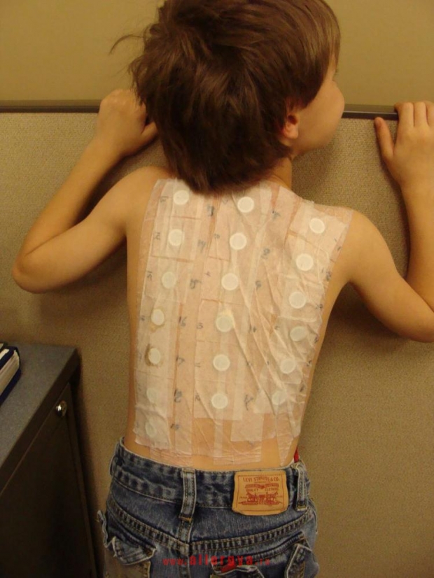 аллегопробы на спине у мальчика