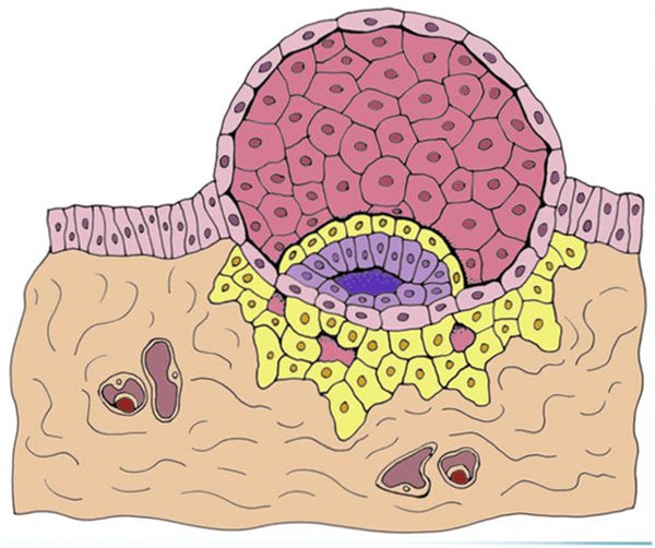 Биохимическая беременность после ЭКО